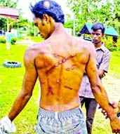 Murad Hossain, a BD fortune seeker who was severely beaten by some Rohingya migrants over fight for food on boat, at Aceh camp on Monday.