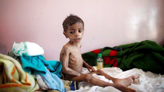 A malnourished boy sits on a bed at a malnutrition treatment centre in Sanaa, Yemen .