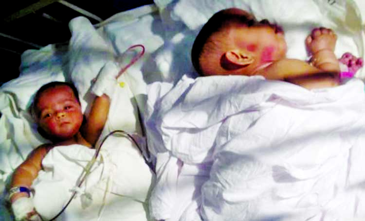 Conjoined twin sisters-Tofa and Tohura of Gaibandha were separated through surgery by doctors at Dhaka Medical College Hosptial (DMCH) on Tuesday.