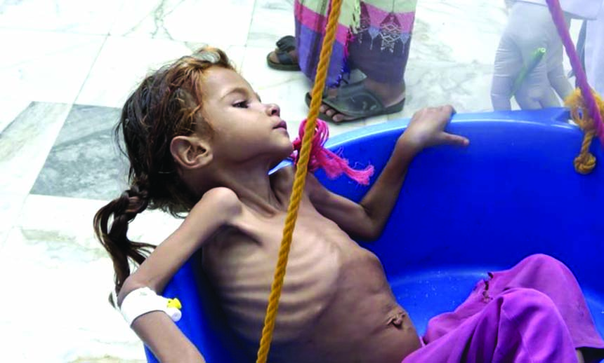 A Yemeni child suffering from malnutrition is measured at a hospital in the Hajjah province, western Yemen, this month.