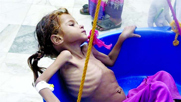 Severely malnourished children were being treated at Aslam Health Centre in Hajjah, Yemen.