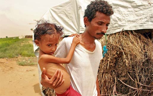 Yemeni Samar Ali Ahmed, 8-year-old weighing nine and a half kilogrammes suffering from acute malnutrition, is carried by her father in Hajjah Governorate, in northern Yemen.