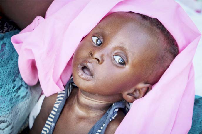 Malnourished five-month old Tiere Pascol, whose mother can't afford food and has trouble breastfeeding, lies in his mother's arms at a feeding center in Al Sabah Children's Hospital in the capital Juba, South Sudan.