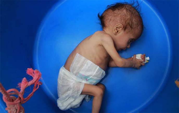 A Yemeni child suffering from malnutrition is weighed at a treatment centre in Yemen's northern Hajjah province.
