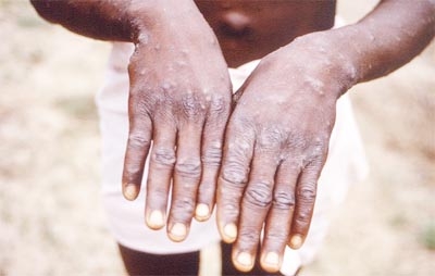 This handout photo provided by the Centers for Disease Control and Prevention was taken during an investigation into an outbreak of monkeypox, which took place in the Democratic Republic of the Congo (DRC).